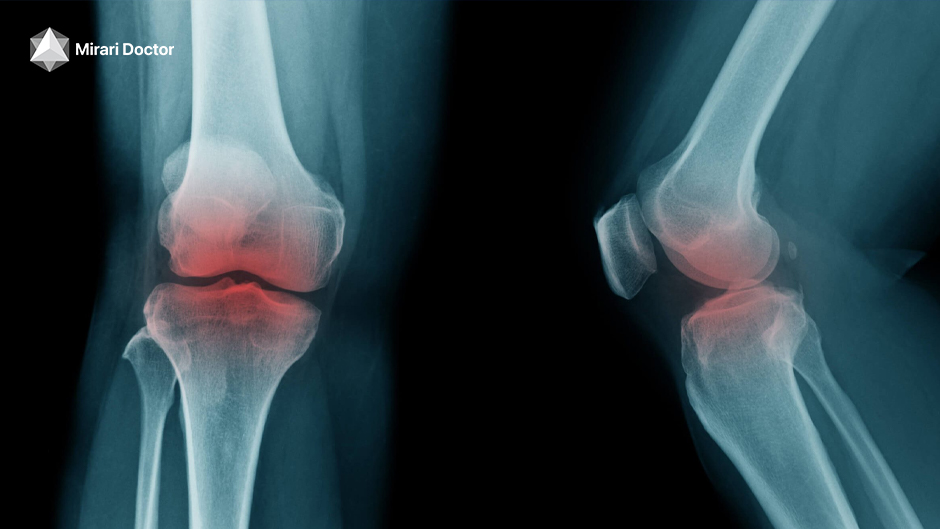 Osteoarthritis