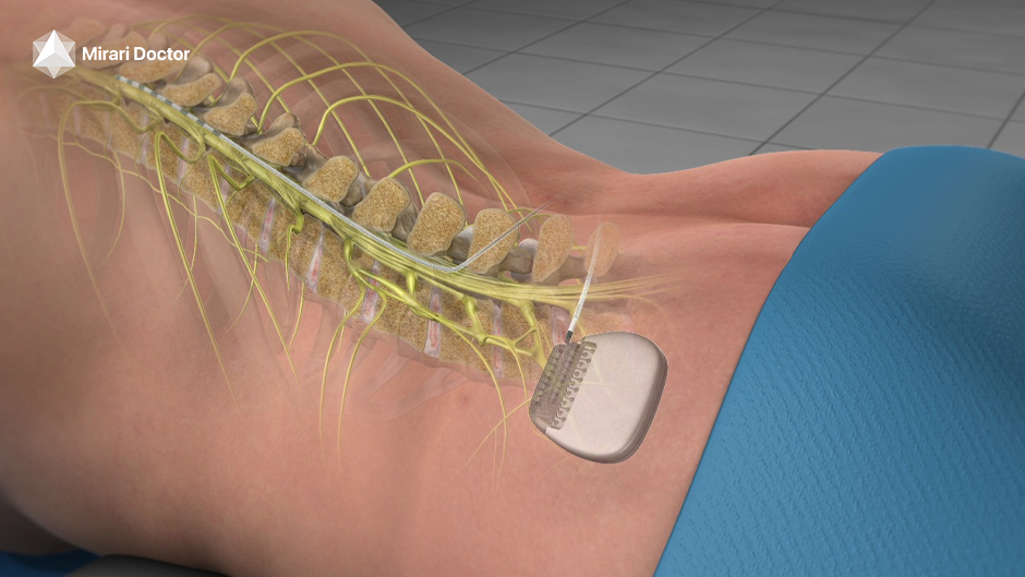 Spinal Cord Stimulation