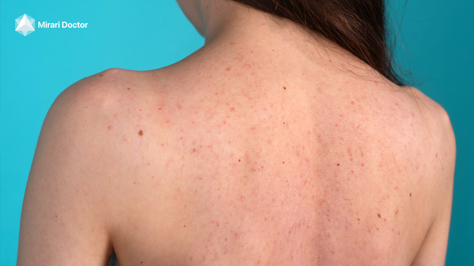 Featured image for “Cold Plasma Applications in Dermatology: Acne and Dermatitis Treatment”