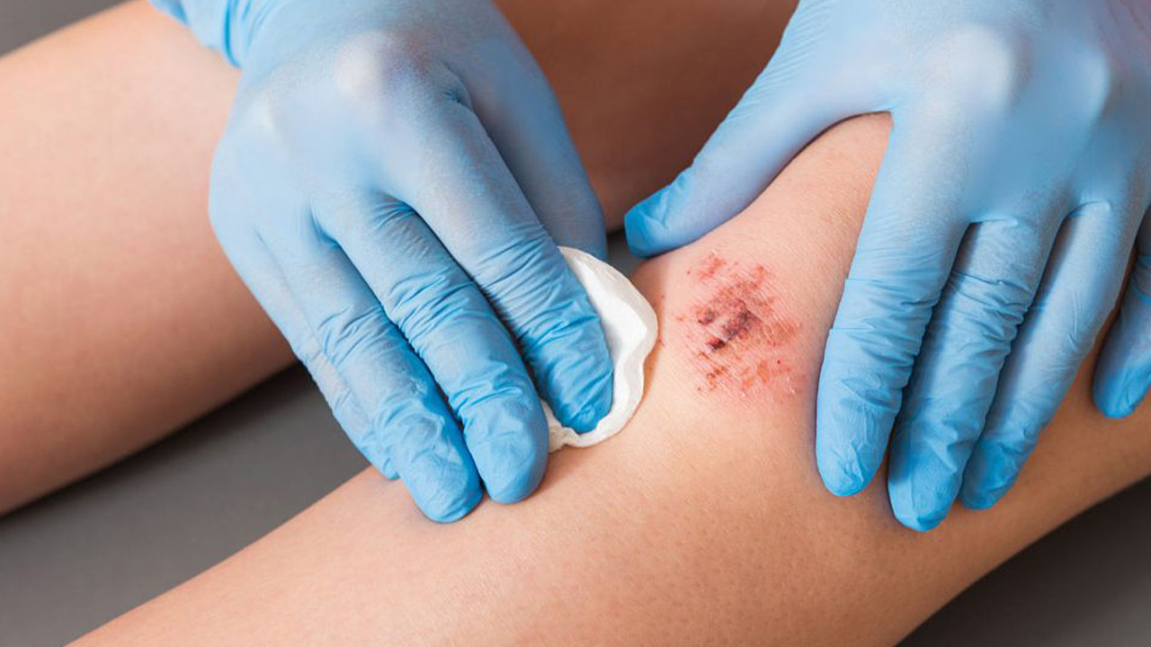 Featured image for “Wound Healing – A Complete Guide to Mirari Cold Plasma Technology and Medical Applications”