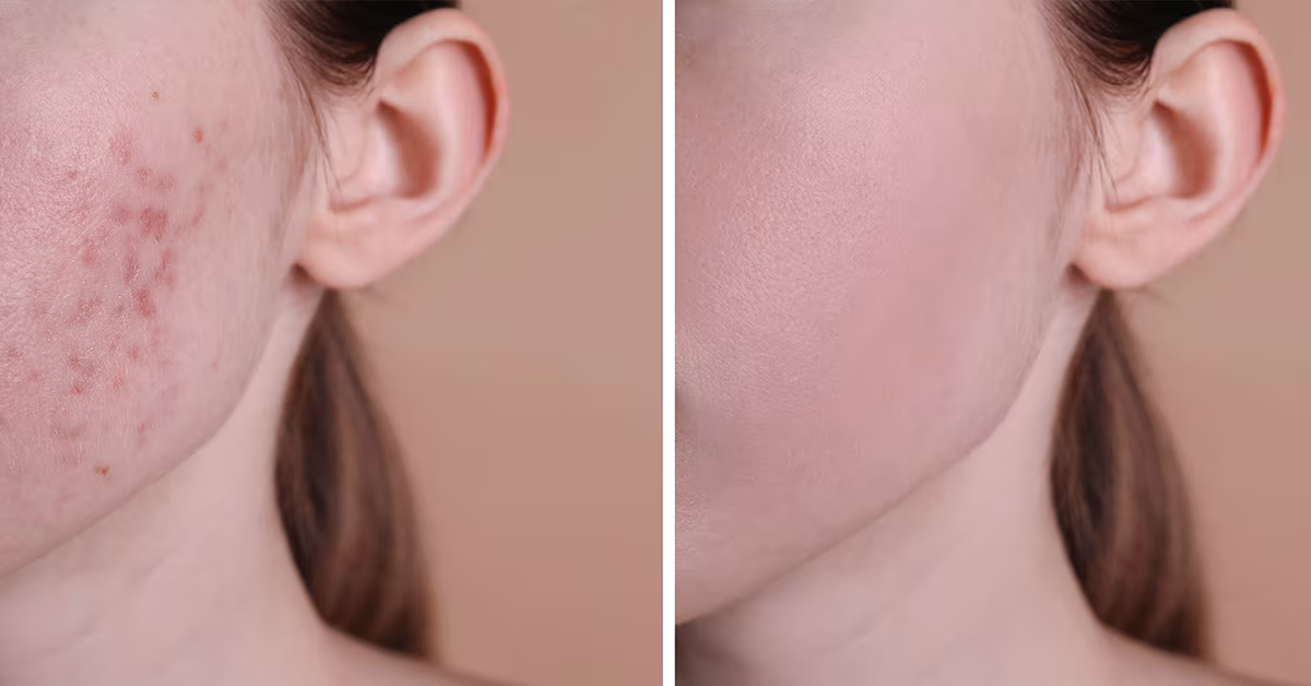 Featured image for “Acne Treatment: Complete Guide to Clear Skin in 2025”