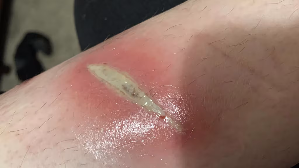 Burn 1