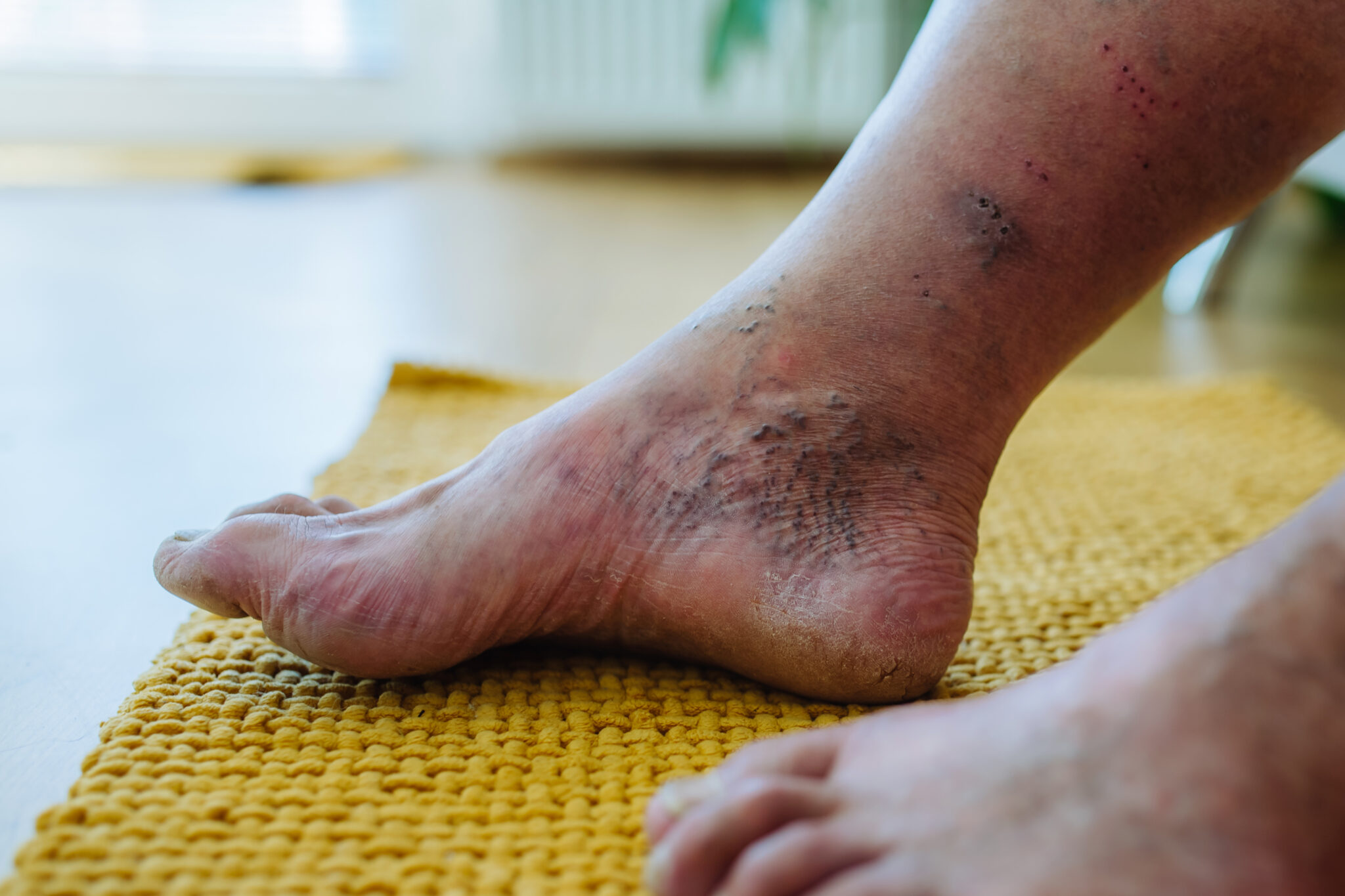 Featured image for “Cold Plasma for Diabetes: Revolutionary Treatment for Diabetic Complications and Wound Healing”