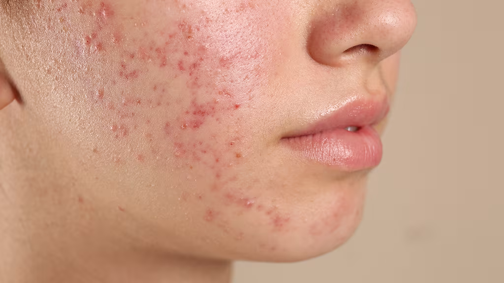 acne