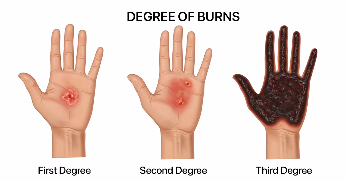 Featured image for “1st 2nd 3rd Degree Burn Treatment: Complete Guide”