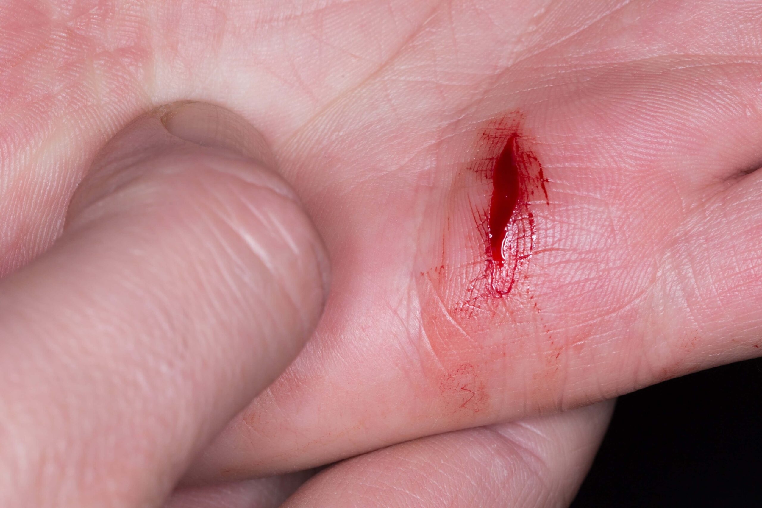 Featured image for “How to Increase Wound Healing? Advanced Strategies for Faster Recovery”