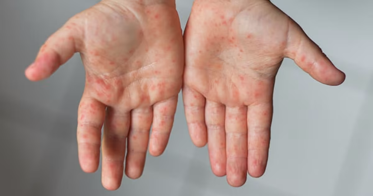Featured image for “Hand Foot and Mouth Disease Treatment: Complete Recovery Guide”